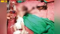 मुंबई | महापालिकेच्या हलगर्जीपणामुळे ३ महिन्यांच्या बाळाने हात गमावला, प्रिन्सची मृत्यूशी झुंज