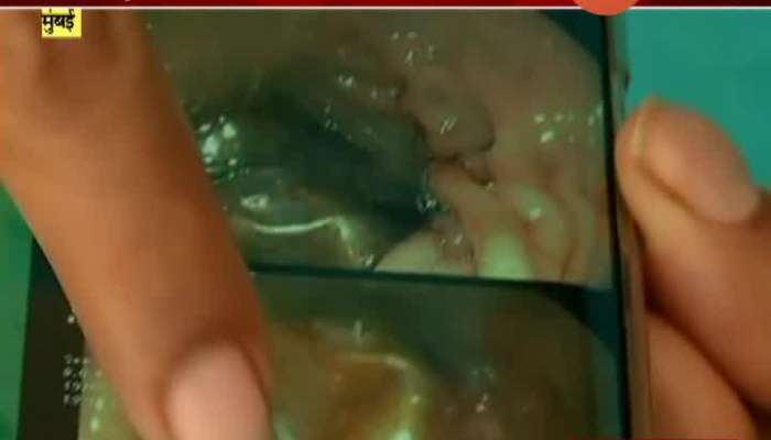 Mumbai Sion Hospital Remove Bottle From Laser Which Stuck In The Gut
