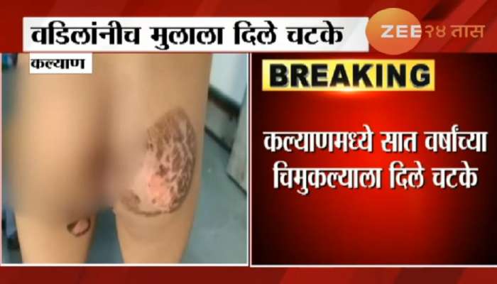 संतापजनक घटना, चड्डीत लघुशंका केल्याने चिमुकल्याला बापाने दिले चटके