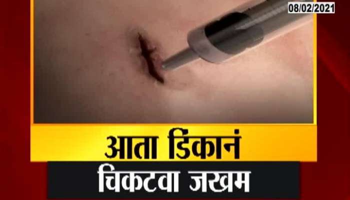 Surgical Boon To Surgeons As No Stiches No Marks From Biomedical Gule
