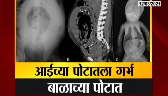 Pimpri 18 Monts Child Got Pregnant Found Fetus In Fetu NEW