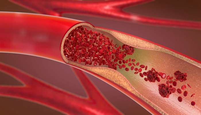 Blood Clot : हाता-पायाच्या दुखण्यासोबत ८ लक्षणांकडे करू नका दुर्लक्ष; ब्लड कॉटचे संकेत