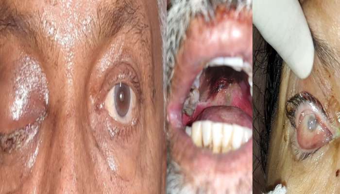 कोरोनाचे साईड इफेक्ट : बापरे ! चक्क डोळे, हिरड्यासह दात काढण्याची वेळ 