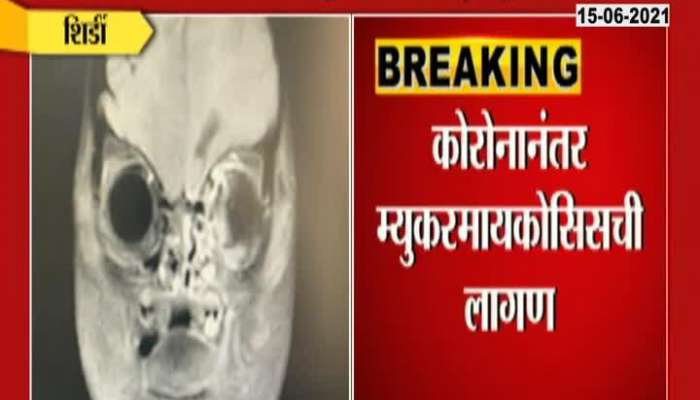 SHIRDI CHILD DEATH DUE TO MUCORMYCOSIS