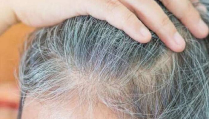 White hair problem remedies: पांढऱ्या केसांची समस्या दूर करतील हे उपाय