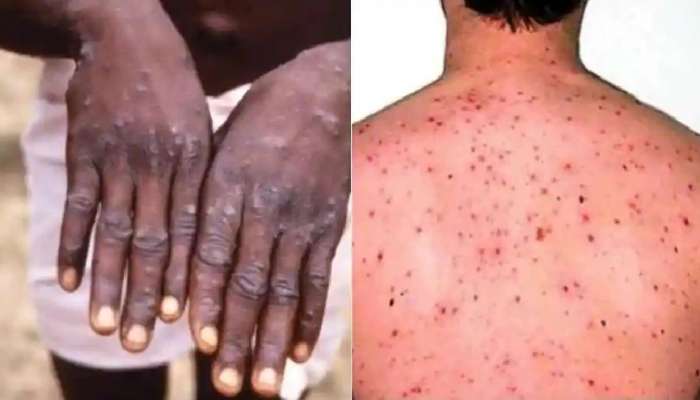 आधीच कोरोनाने बेजार, त्यात आता 18 वर्षांपूर्वीचा आजार, काय आहे Monkeypox? जाणून घ्या लक्षणं