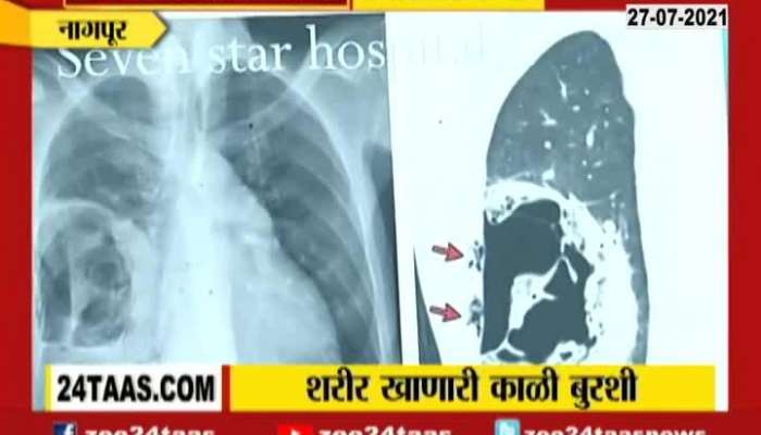 Nagpur Mucormycosis Infects Other Organs Also In A Case