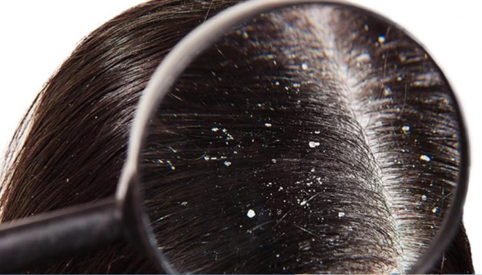 Dandruff Remedies: केसांना फक्त तेल लावल्याने वाढू शकतो डँड्रफ; वाचा खास उपाय