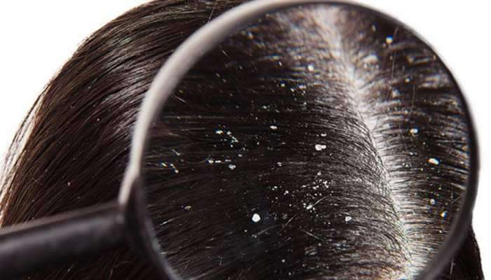 Dandruff treatment : डोक्यातील कोंडा दूर करण्यासाठी घरगुती उपाय