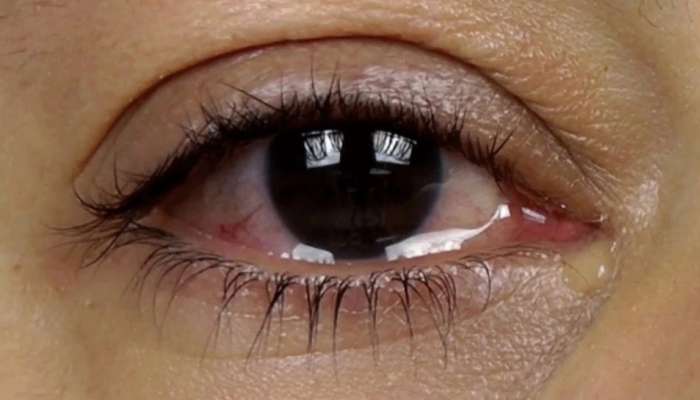 Eye Care: तुमच्या डोळ्यातून ही सारखं पाणी येतं का? तर ही गोष्ट केली पाहिजे