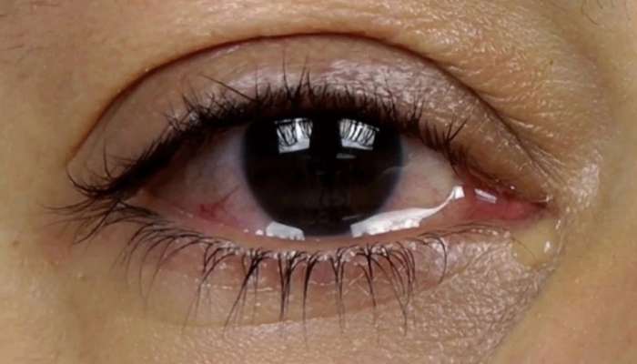 Eye Care: तुमच्या डोळ्यातून ही सारखं पाणी येतं का? तर ही गोष्ट केली पाहिजे