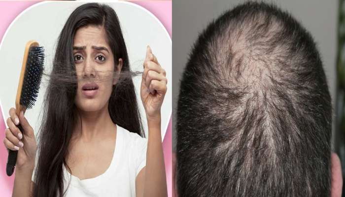 Reason of hair loss: या ५ कारणांमुळे गळतात केस, अशी रोखू शकता केस गळती
