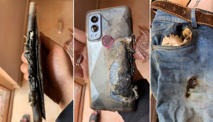 OnePlusचा पॅन्टच्या खिशात स्फोट, या व्यक्तीची काय अवस्था झाली पाहा फोटो