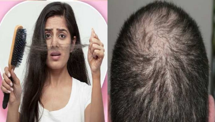 Hair Fall | हे 5 पदार्थ खाल्ल्याने केसगळतीचं प्रमाण अधिक वाढतं 