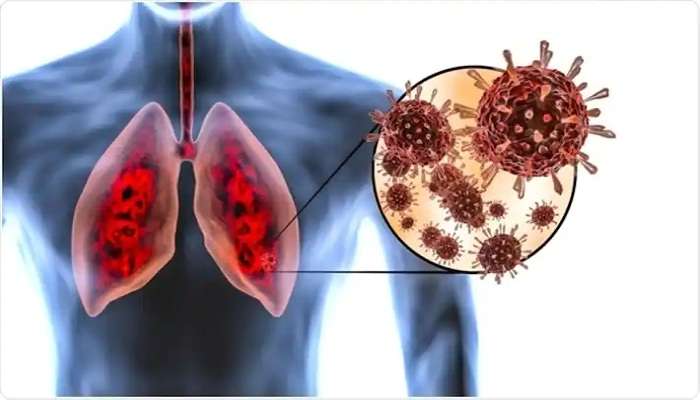 Omicron And Lungs : ओमायक्रॉन फुफ्फुसाकरता किती घातक? अभ्यासात खुलासा 