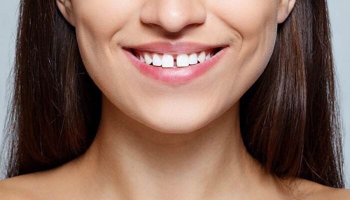 तुमच्याही समोरच्या दातांमध्ये आहे फट? शास्त्र काय सांगतं वाचून व्हाल थक्क 