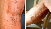 तुमच्या पायातही निळ्या नसा दिसतात का? हे गंभीर समस्येचे लक्षण असू शकते