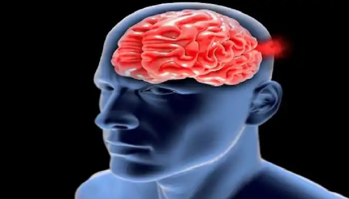 Brain Aneurysm ची काय आहेत लक्षणं?; पाहा धोकादायक परिस्थिती कधी उद्भवते