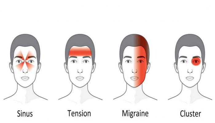 डोकेदुखीचे 4 प्रकार आहेत, यातील तुम्हाला होणारी डोकेदुखी कोणत्या प्रकारची? जाणून घ्या