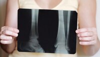 Bone Health: तुमच्या 'या' चुकीच्या सवयींमुळे कमकुवत होतायत हाडं