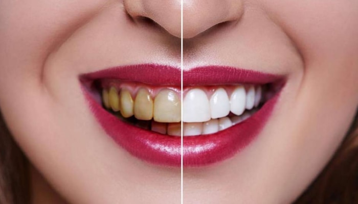 Teeth Cleaning: &#039;या&#039; घरगुती उपयांनी दात होतील मोत्यासारखे पांढरे शुभ्र