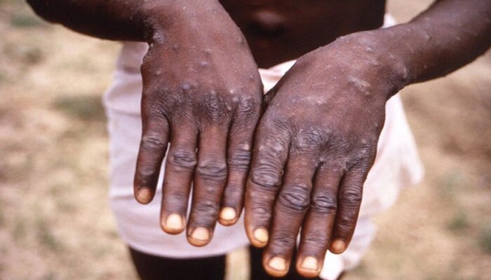 मुंबईला Monkeypox चा धोका? मुंबई महापालिका अलर्टवर!