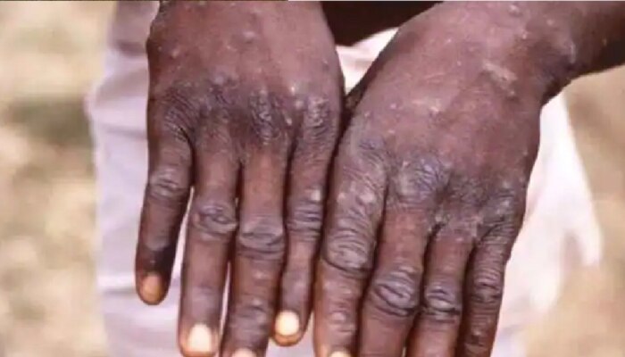 Monkeypox चा धोका वाढला! या ठिकाणी रूग्णांसाठी 21 दिवस क्वारंटाईन अनिवार्य 