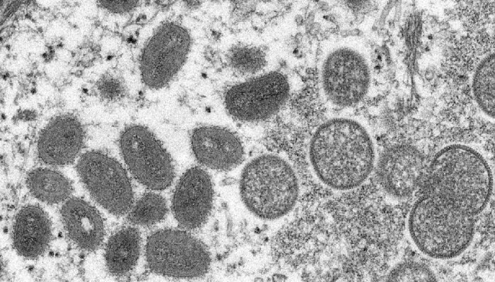 रक्त आणि throat swab मध्ये सापडला Monkeypox virus, उपचारांवर लॅन्सेटचा रिसर्च
