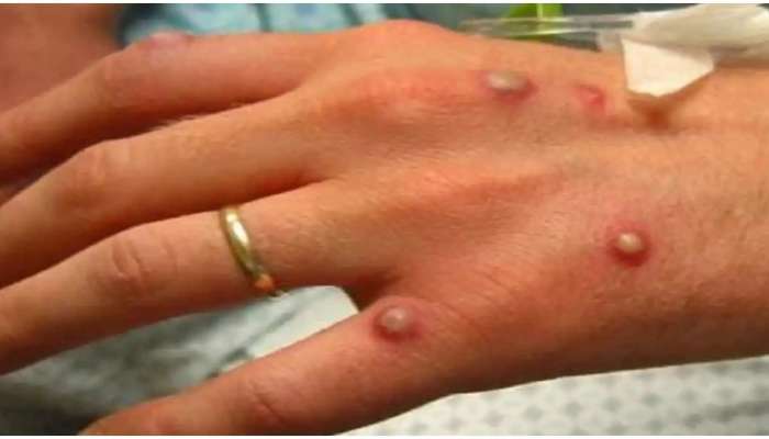 'या' राज्यात Monkeypox चा धोका? सरकार अलर्टवर, नव्या गाइडलाईन्स जारी