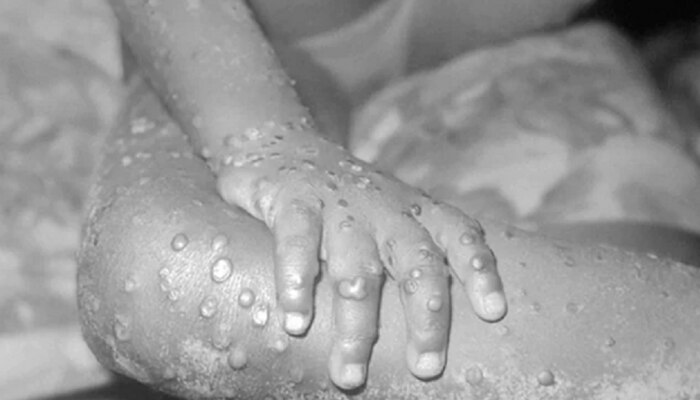 Monkeypox : 20 देशांत मंकीपॉक्सचा उद्रेक, प्रसार रोखण्यासाठी जलद पावले उचलण्याचे WHO च्या सूचना