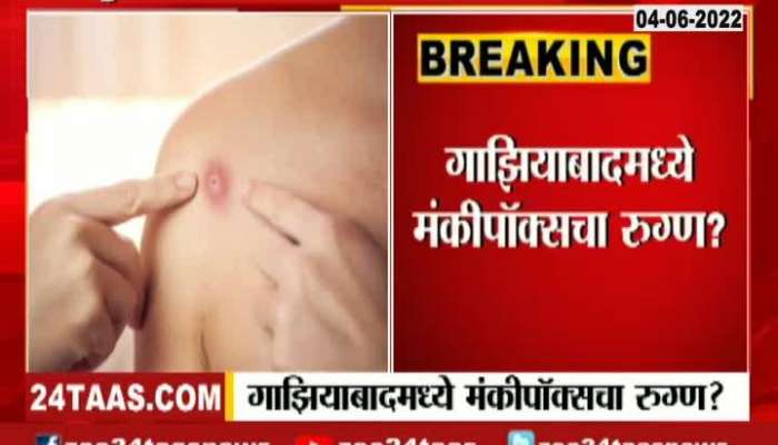 Gaziabad Five Years Small Girl Infected From Monkey Pox