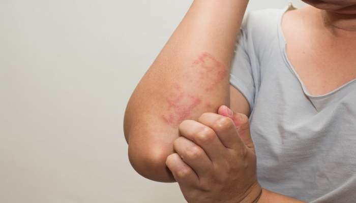 Skin disorder : आयुर्वेदानुसार त्वचा संदर्भात समस्या असल्यास हे पदार्थ खाणे टाळावे