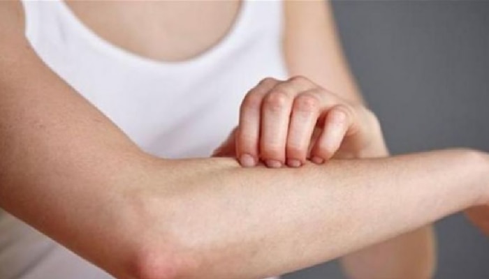 पावसाळ्यात Fungal Infection पासून दूर राहण्यासाठी घ्या ही काळजी