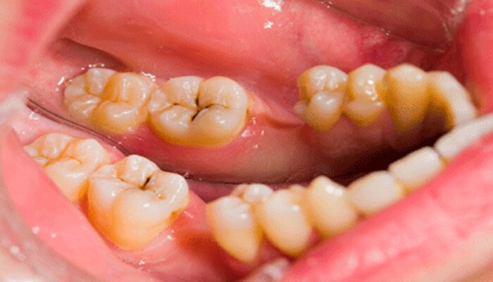 दात किडन्याच्या समस्येने त्रस्त असाल, तर हे 3 घरगुती उपाय करा