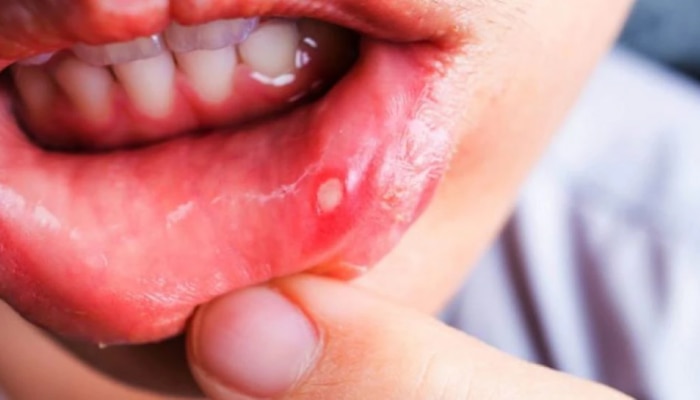 Mouth Ulcers : तुम्ही देखील तोंड येण्याच्या समस्येनं त्रस्त आहात? मग &#039;हा&#039; उपाय नक्की करुन पाहा