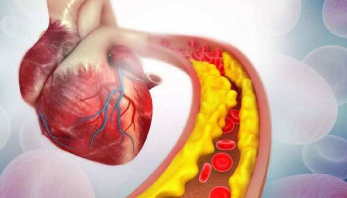 Cholesterol वाढल्यानंतर शरीरात दिसून येतात हे बदल, आजंच सावध व्हा नाहीतर...!