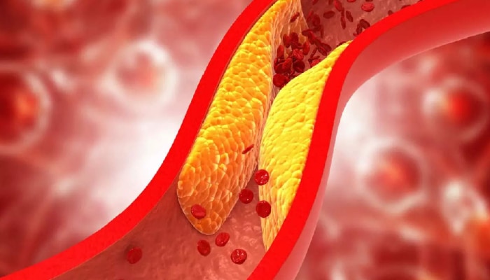 Cholesterol नैसर्गिक पद्धतीने कमी करण्याचे 5 रामबाण उपाय