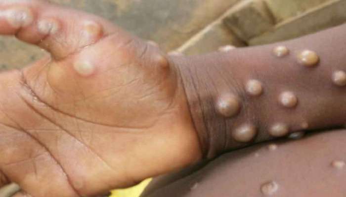 देशातील &#039;या&#039; राज्यात सापडला Monkeypox चा पहिला रुग्ण? 