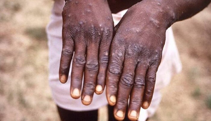 Monkeypox : मंकीपॉक्सचा धोका, केंद्र सरकार अलर्ट मोडवर, राज्यांना केल्या या सूचना