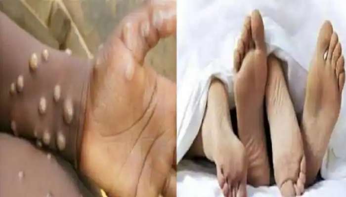 Sexual Activity मुळे मंकीपॉक्स वेगाने पसरतोय? अभ्यासातून धक्कादायक खुलासा