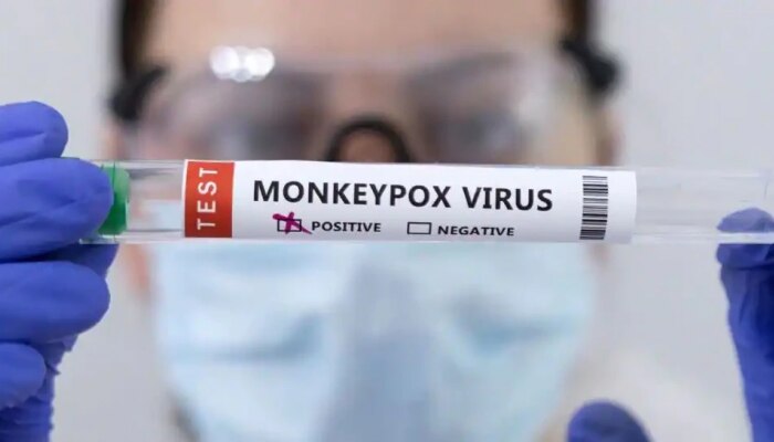 Monkeypox : चिंता वाढली; परदेशी प्रवास न केलेल्या रूग्णालाही मंकीपॉक्सची लागण, देशातील असा पहिला रूग्ण