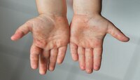लहान मुलांना Monkeypox चा किती धोका? यावर लस आहे का?  प्रत्येक प्रश्नाचं उत्तर