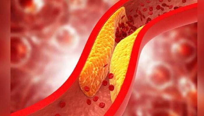 आता Cholesterol ला अजिबात घाबरू नका; &#039;या&#039; गोष्टींनी कमी होईल खराब कोलेस्ट्रॉल