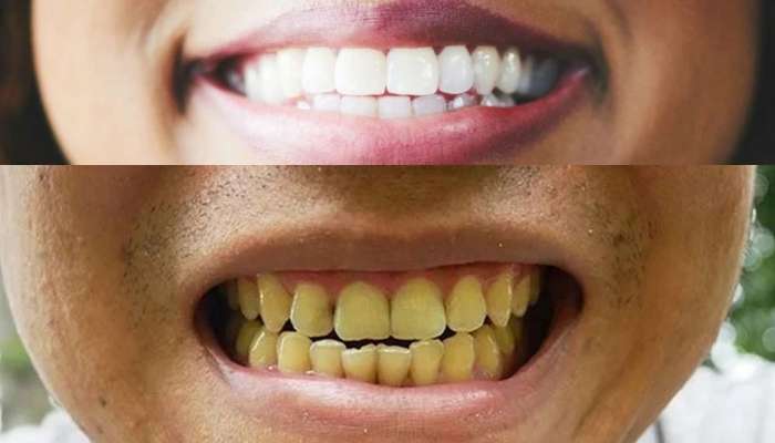 Teeth Whitening: तुमचे दात पिवळे पडलेत? घरातील फळांनी कराल मोत्यासारखे स्वच्छ