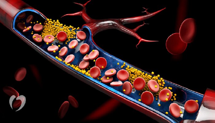 शरीरात अचानक Cholesterol वाढवू शकतात &#039;या&#039; गोष्टी; आजच दूर करा