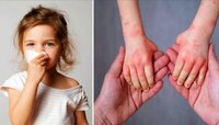 देशात Tomato Flu ने वाढवलं टेन्शन, केंद्र सरकार पुन्हा अलर्टवर