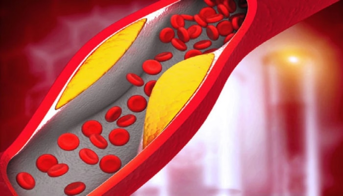 High Cholesterol : &#039;या&#039; गोष्टींमुळे वाढतंय रक्तवाहिन्यांमध्ये कोलेस्ट्रॉल, आजच सावध व्हा