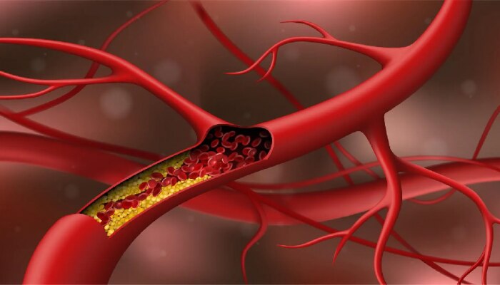 Bad Cholesterol: आता गोळ्यांची गरजही पडणार नाही, &#039;असं&#039; कमी करू शकता कोलेस्ट्रॉल