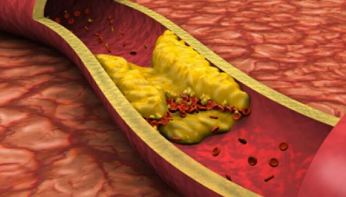 High cholesterol: शरीराच्या &#039;या&#039; भागाची त्वचा कोरडी पडलीये? cholesterol वाढण्याचे संकेत