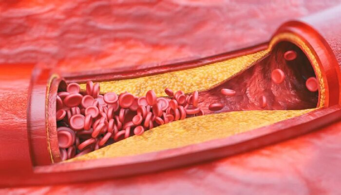 हार्ट अटॅक टाळायचा असेल तर &#039;या&#039; वयापासूनच Cholesterol ची पातळी तपासणं करा सुरू